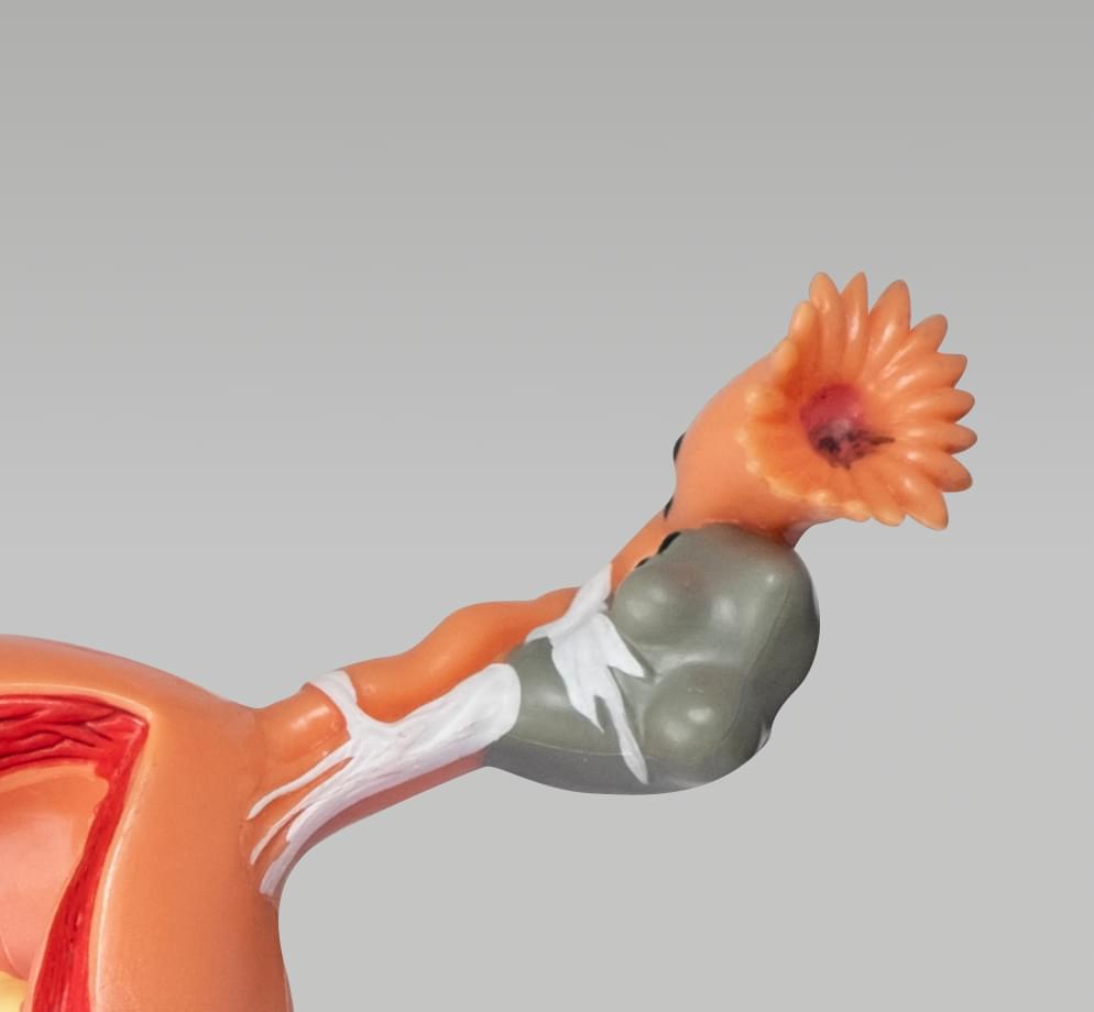 Картинка с больными яичниками